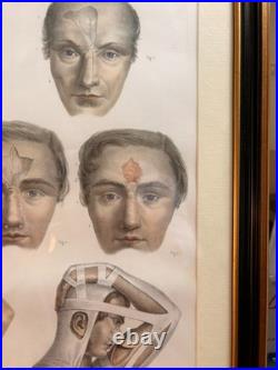 Gravure Chirurgie plastique Rhinoplastique NICOLAS HENRI Jacob Bourgery Anatomie