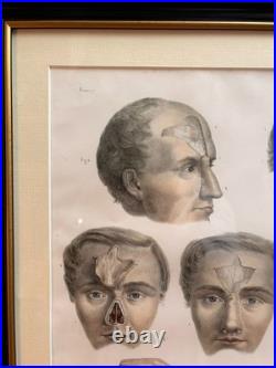 Gravure Chirurgie plastique Rhinoplastique NICOLAS HENRI Jacob Bourgery Anatomie