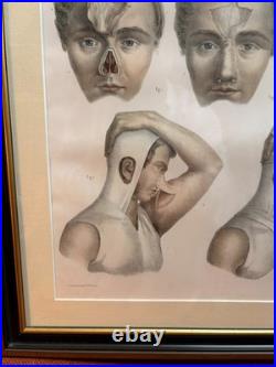 Gravure Chirurgie plastique Rhinoplastique NICOLAS HENRI Jacob Bourgery Anatomie